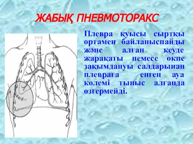 ЖАБЫҚ ПНЕВМОТОРАКС Плевра қуысы сыртқы ортамен байланыспайды және алған кеуде жарақаты