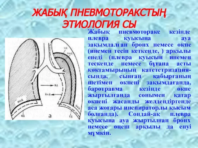 ЖАБЫҚ ПНЕВМОТОРАКСТЫҢ ЭТИОЛОГИЯ СЫ Жабық пневмоторакс кезінде плевра қуысына ауа зақымдалған