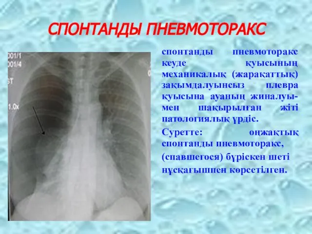 СПОНТАНДЫ ПНЕВМОТОРАКС спонтанды пневмоторакс кеуде қуысының механикалық (жарақаттық) зақымдалуынсыз плевра қуысына