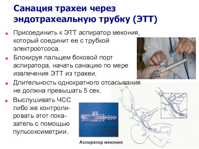 Санация трахеи через эндотрахеальную трубку (ЭТТ) Присоединить к ЭТТ аспиратор мекония,