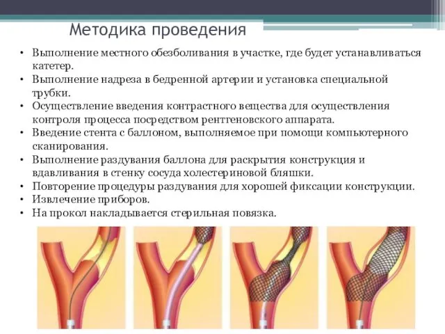 Методика проведения Выполнение местного обезболивания в участке, где будет устанавливаться катетер.