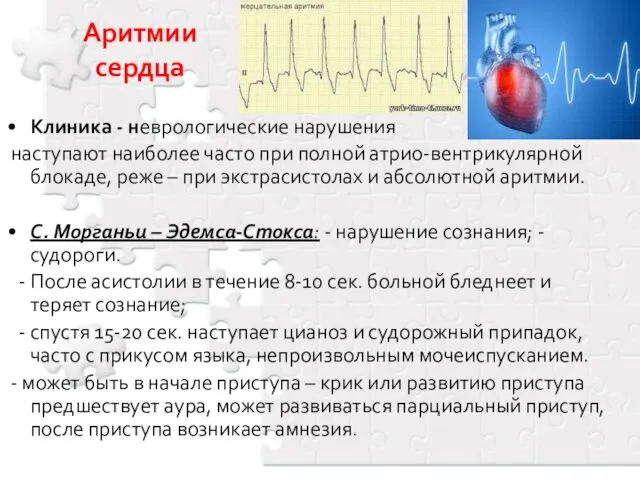 Аритмии сердца Клиника - неврологические нарушения наступают наиболее часто при полной