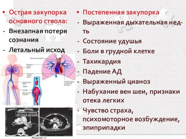 Острая закупорка основного ствола: Внезапная потеря сознания Летальный исход Постепенная закупорка