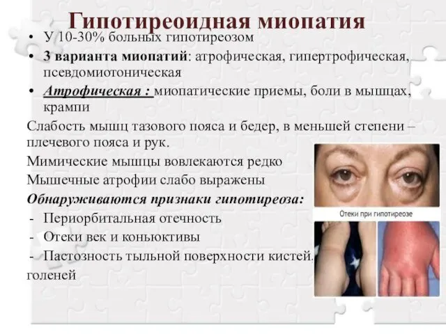 Гипотиреоидная миопатия У 10-30% больных гипотиреозом 3 варианта миопатий: атрофическая, гипертрофическая,