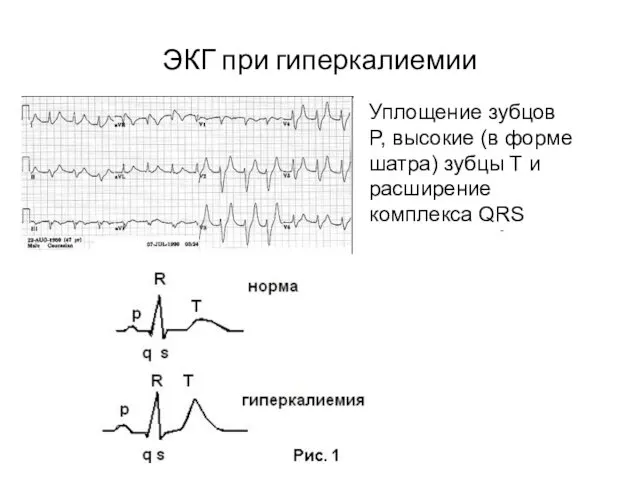 ЭКГ при гиперкалиемии Уплощение зубцов P, высокие (в форме шатра) зубцы Т и расширение комплекса QRS