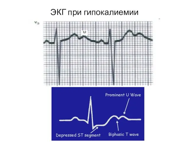 ЭКГ при гипокалиемии