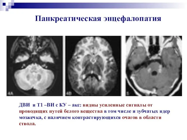 Панкреатическая энцефалопатия ДВИ и Т1 –ВИ с КУ – акс: видны