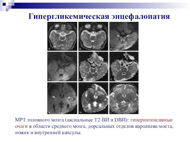 МРТ головного мозга (аксиальные Т2-ВИ и DВИ): гиперинтенсивные очаги в области