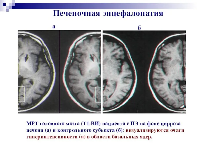 Печеночная энцефалопатия МРТ головного мозга (Т1-ВИ) пациента с ПЭ на фоне