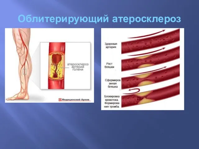 Облитерирующий атеросклероз