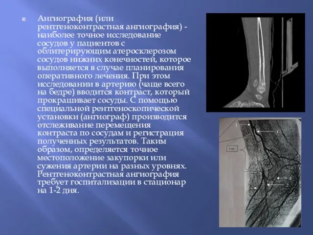 Ангиография (или рентгеноконтрастная ангиография) - наиболее точное исследование сосудов у пациентов