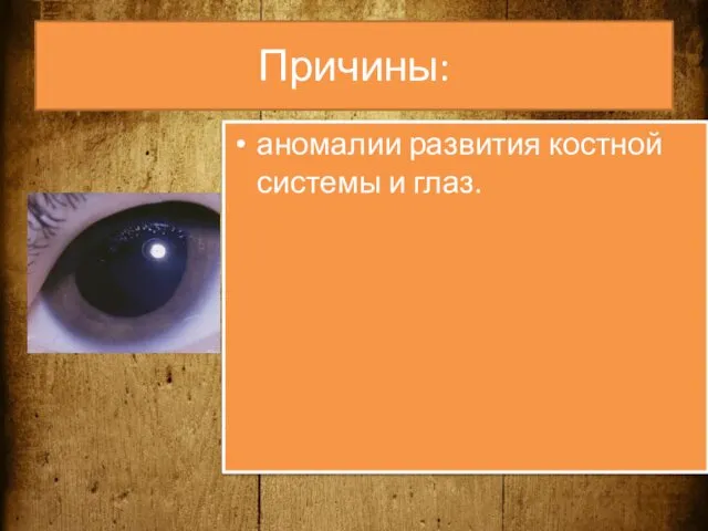 Причины: аномалии развития костной системы и глаз.