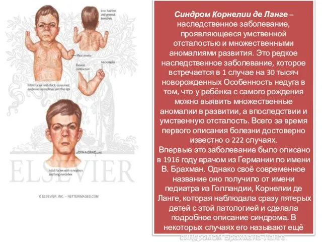 М Синдром Корнелии де Ланге – наследственное заболевание, проявляющееся умственной отсталостью