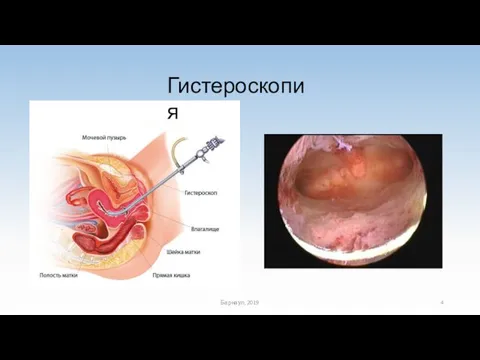 Гистероскопия Барнаул, 2019