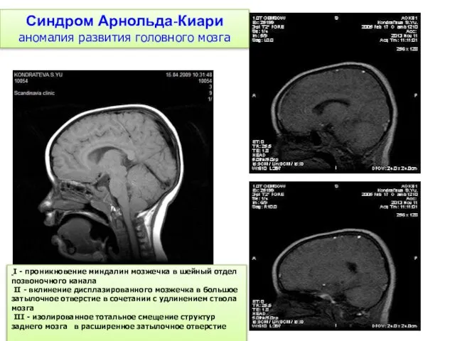 Синдром Арнольда-Киари аномалия развития головного мозга I - проникновение миндалин мозжечка