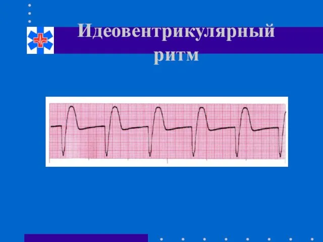 Идеовентрикулярный ритм