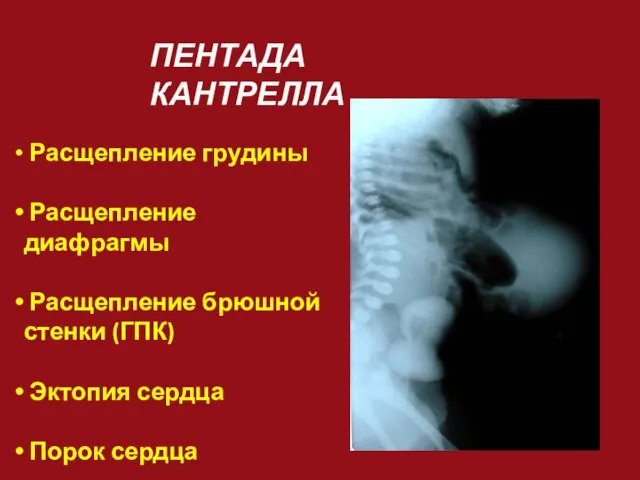 ПЕНТАДА КАНТРЕЛЛА Расщепление грудины Расщепление диафрагмы Расщепление брюшной стенки (ГПК) Эктопия сердца Порок сердца