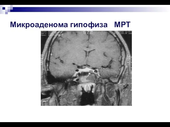 Микроаденома гипофиза МРТ