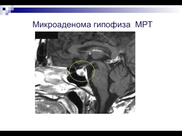 Микроаденома гипофиза МРТ