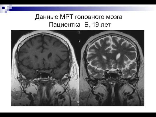 Данные МРТ головного мозга Пациентка Б, 19 лет