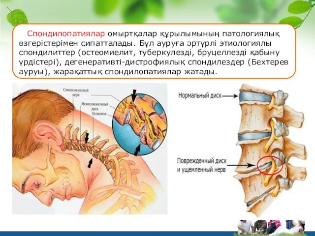 Спондилопатиялар омыртқалар құрылымының патологиялық өзгерістерімен сипатталады. Бұл ауруға әртүрлі этиологиялы спондилиттер