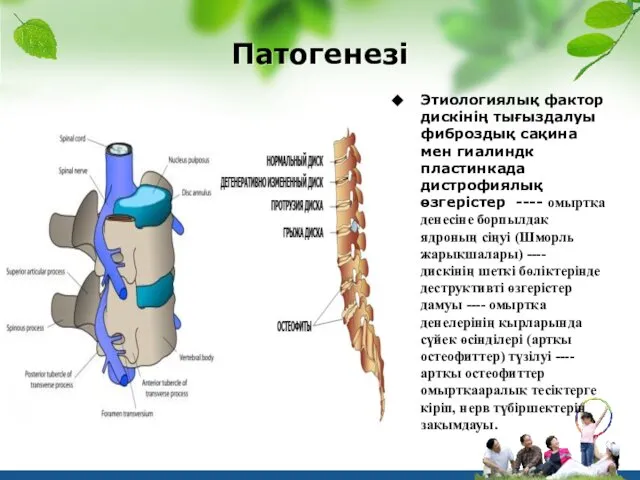 Патогенезі Этиологиялық фактор дискінің тығыздалуы фиброздық сақина мен гиалиндк пластинкада дистрофиялық