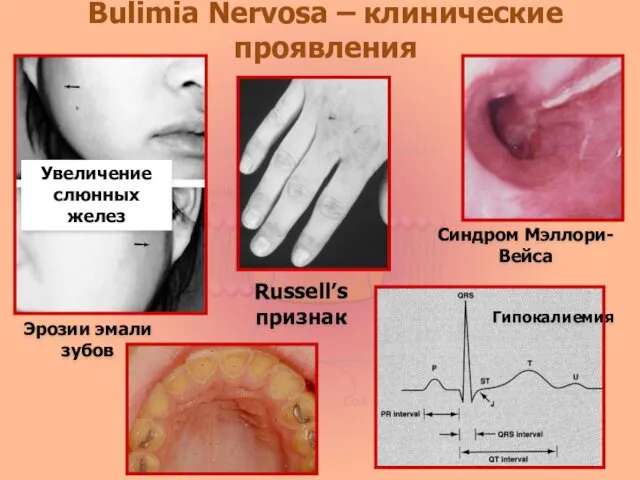 Bulimia Nervosa – клинические проявления Увеличение слюнных желез Синдром Мэллори-Вейса Russell’sпризнак Гипокалиемия Эрозии эмали зубов