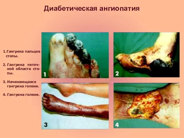 Диабетическая ангиопатия 1.Гангрена пальцев стопы. 2. Гангрена пяточ- ной области сто-