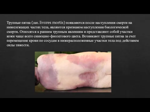 Трупные пятна (лат. livores mortis) появляются после наступления смерти на нижележащих