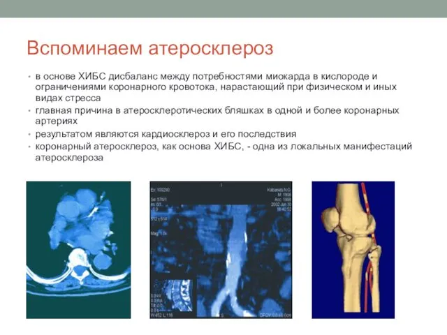 Вспоминаем атеросклероз в основе ХИБС дисбаланс между потребностями миокарда в кислороде