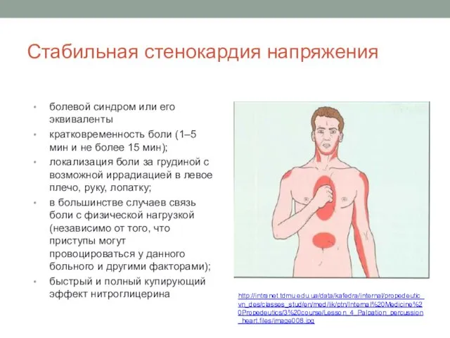 Стабильная стенокардия напряжения болевой синдром или его эквиваленты кратковременность боли (1–5