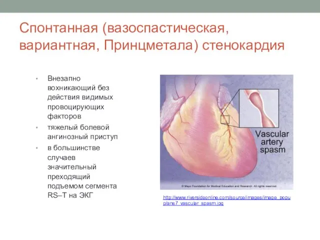 Спонтанная (вазоспастическая, вариантная, Принцметала) стенокардия Внезапно вохникающий без действия видимых провоцирующих