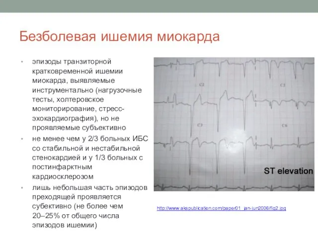 Безболевая ишемия миокарда эпизоды транзиторной кратковременной ишемии миокарда, выявляемые инструментально (нагрузочные