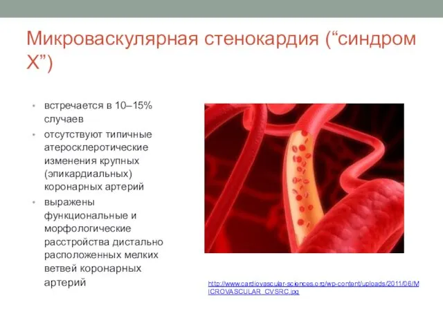 Микроваскулярная стенокардия (“синдром Х”) встречается в 10–15% случаев отсутствуют типичные атеросклеротические