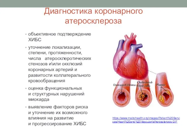 Диагностика коронарного атеросклероза объективное подтверждение ХИБС уточнение локализации, степени, протяженности, числа