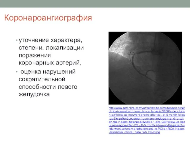 Коронароангиография уточнение характера, степени, локализации поражения коронарных артерий, оценка нарушений сократительной способности левого желудочка http://www.pcronline.com/var/pcr/storage/images/pcronline/clinical-cases/cardiovascular-center-aalst/2006/subocclusion-lcx/follow-up-recurrent-angina-after-pci.-at-5-month-follow-up-the-patient-underwent-coronary-angiogram-and-re-pci-on-rca-in-stent-restenosis/322064-1-eng-GB/Follow-up-Recurrent-angina-after-PCI.-At-5-month-follow-up-the-patient-underwent-coronary-angiogram-and-re-PCI-on-RCA-in-stent-restenosis_clinical_case_tab_zoom.jpg