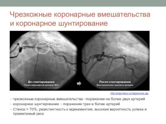 Чрезкожные коронарные вмешательства и коронарное шунтирование чрезкожные коронарные вмешательства –поражение не