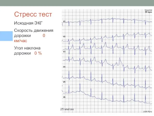 25 мм/сек Стресс тест Исходная ЭКГ Скорость движения дорожки 0 км/час Угол наклона дорожки 0 %