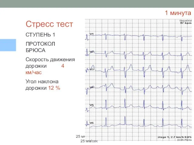 1 минута 25 мм/сек Стресс тест СТУПЕНЬ 1 ПРОТОКОЛ БРЮСА Скорость