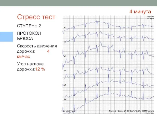 Стресс тест СТУПЕНЬ 2 ПРОТОКОЛ БРЮСА Скорость движения дорожки: 4 км/час