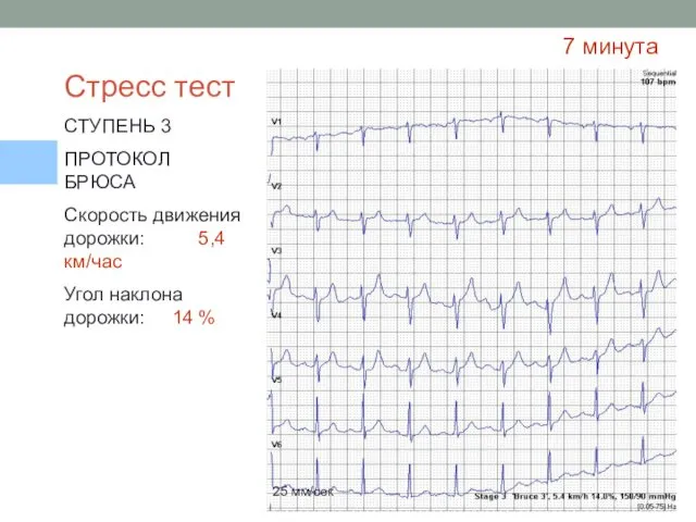 Стресс тест СТУПЕНЬ 3 ПРОТОКОЛ БРЮСА Скорость движения дорожки: 5,4 км/час