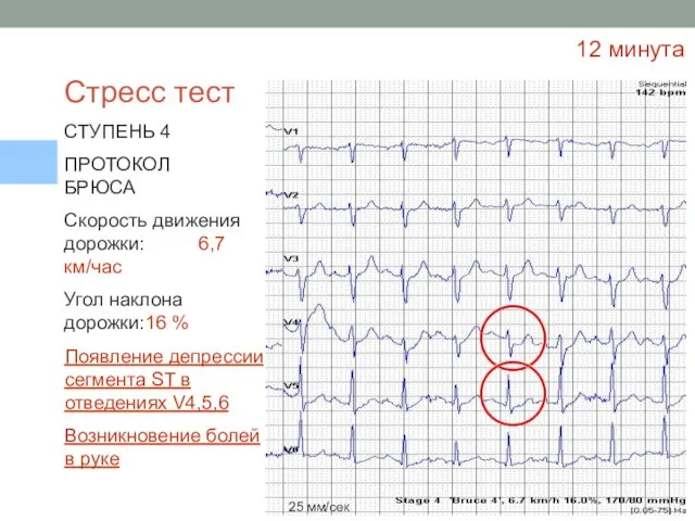 Стресс тест СТУПЕНЬ 4 ПРОТОКОЛ БРЮСА Скорость движения дорожки: 6,7 км/час