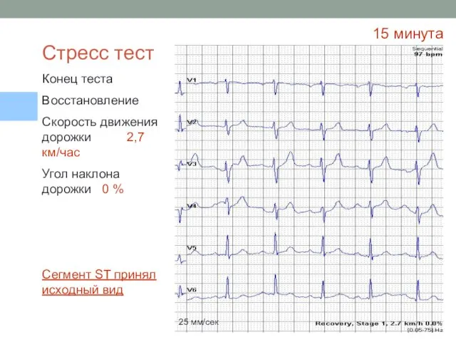 15 минута 25 мм/сек Сегмент ST принял исходный вид Стресс тест