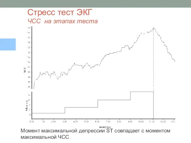 Стресс тест ЭКГ ЧСС на этапах теста Момент максимальной депрессии ST совпадает с моментом максимальной ЧСС