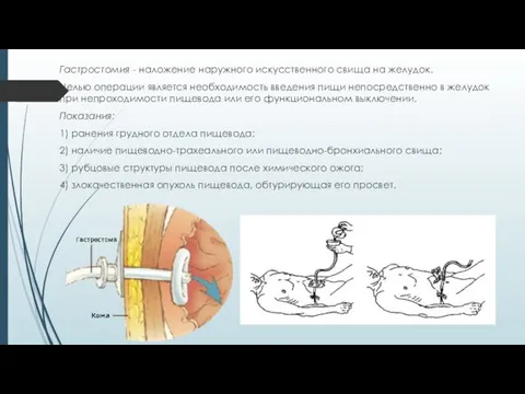 Гастростомия - наложение наружного искусственного свища на желудок. Целью операции является