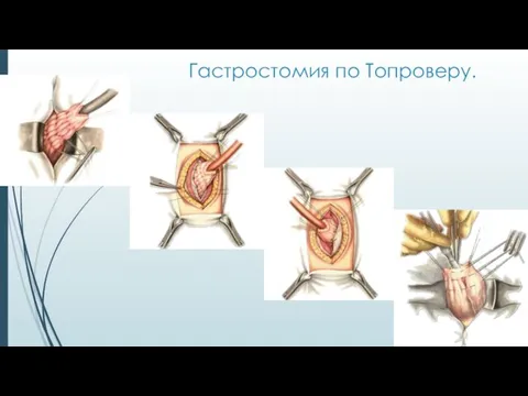 Гастростомия по Топроверу.