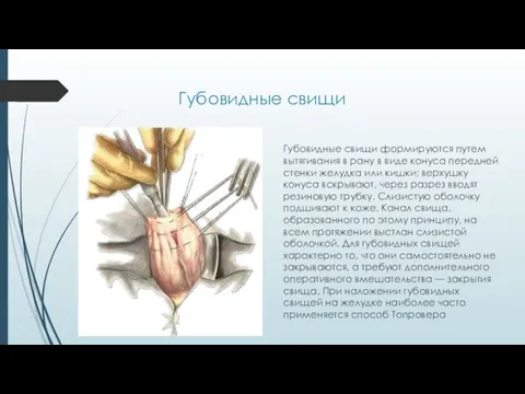 Губовидные свищи Губовидные свищи формируются путем вытягивания в рану в виде