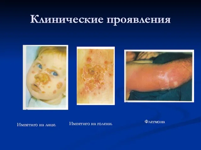 Клинические проявления Импетиго на лице. Импетиго на голени. Флегмона