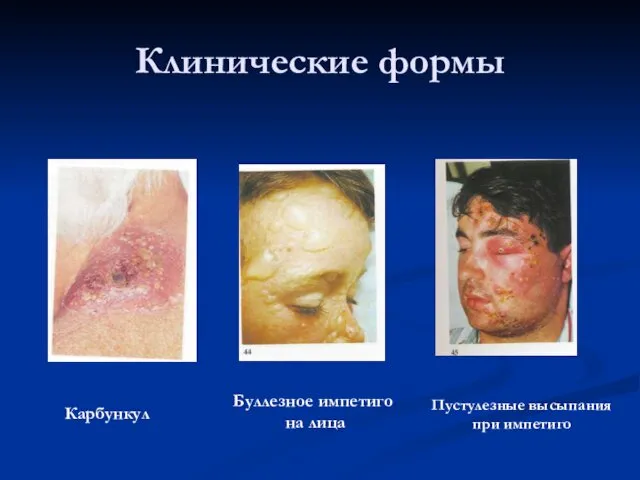Клинические формы Карбункул Буллезное импетиго на лица Пустулезные высыпания при импетиго