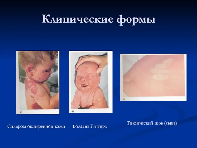 Клинические формы Синдром ошпаренной кожи Болезнь Риттера Токсический шок (сыпь)